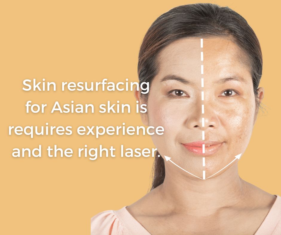 Skin Tightening asian skin