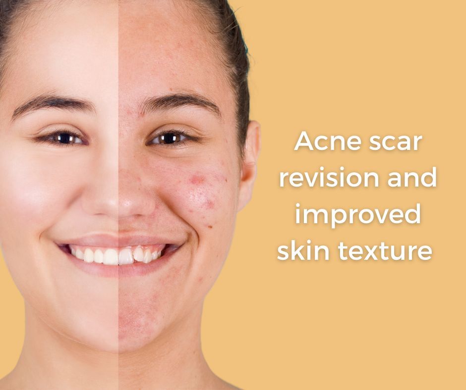 Skin tightening centers microneedling acne