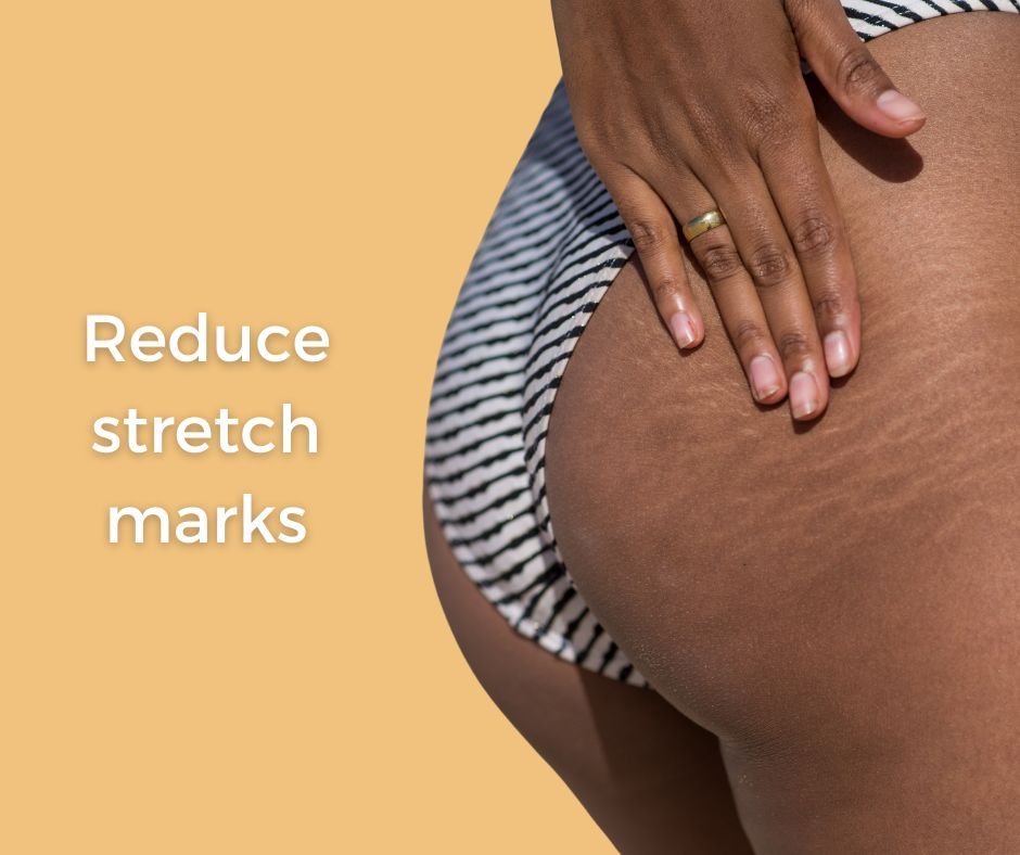 Skin tightening centers microneedling stretch marks