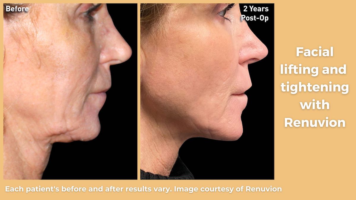 Renuvion facial skin tightening